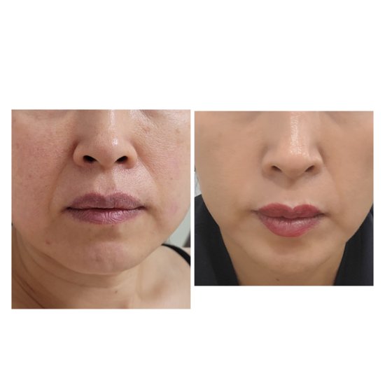 Resultados antes y después registrados con el diario fotográfico del skin coach Protocol Hub en las semanas 1 a 12